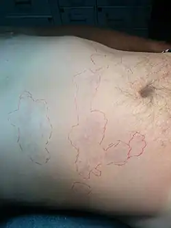 جلد مرمري في مريضٍ مُصاب بالنوع الأول من مرض تخفيف الضغط (DCS)