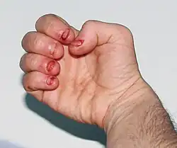 عض الأظافر المتطرف / عض الجلد كجزء من اضطراب الوسواس القهري (OCD) أو أي حالة أخرى تؤدي إلى تشويه الذات مثل طيف التوحد (كما هو الحال في هذا المثال) أو متلازمة لش-نيهان.