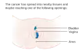 Stage 2 vulvar cancer