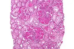 صورة مجهرية of diffuse proliferative lupus nephritis showing increased mesangial matrix and mesangial hypercellularity. خزعة كلوية. ملون حمض شيف الدوري.