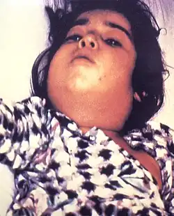 يسبب الخناق تضخما مميزا في العنق، يشار إليه في بعض الأحيان بمصطلح "رقبة الثور"، نظرا لتشابه شكل التضخم مع رقبة ذاك الحيوان.