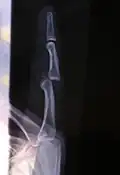 Lateral X-ray of left finger, showing proximal interphalangeal joint dislocation and fracture of the base of the middle phalanx