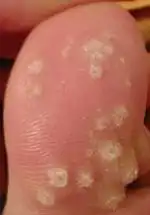 ثؤلول