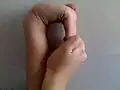 فرط الحركية في ثني المعصم و الأصابع للخلف.