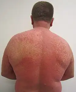 طفح جلدي أحمر بسبب تفاعل دوائي.