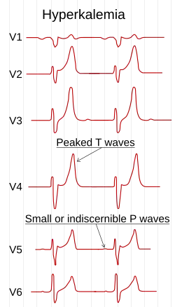 تخطيط كهربائية القلب showing تخطيط كهربائية القلبs in hyperkalemia.