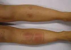 Erythema nodosum in a person who had recently had التهاب البلعوم العقدي