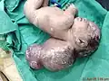 مولود لديه قيلة دماغية كبيرة الحجم.