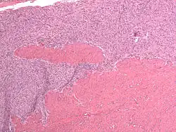 صورة مجهرية لساركومة بطانية سدوية رحمية ذات درجة منخفضة صبغة H&E.