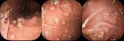 صورة بالمنظار لداء سلائل غدد قاع المعدة التُقطت عند ثني المنظار إلى الخلف.