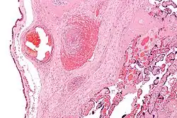 Intermediate magnification micrograph of the placental disc showing a thrombosed fetal vein, as may be seen in fetal thrombotic vasculopathy. صبغة الهيماتوكسيلين واليوزين.