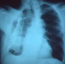 Fibrothorax on chest x-ray