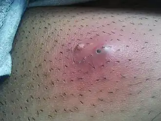 خراج بعمر 5 أيام