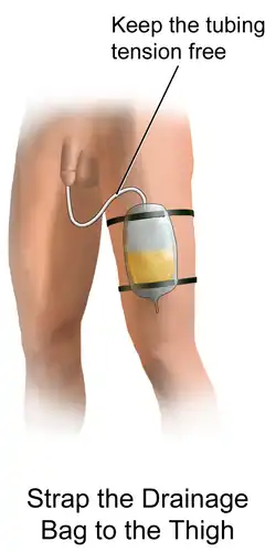 قسطرة فولي مع جهاز تجميع