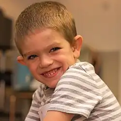 Boy with fragile X syndrome