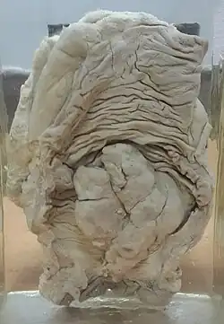 سرطان القولون