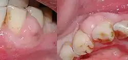 خراج لثوي بين الناب السفلي الأيسر والضرس الأول.