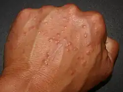 ورم حبيبي حلقي (جلدية)