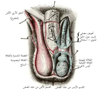 كيس الصفن. على الجانب الأيسر تم فتح تجويف الغلالة الغمدية للخصية. على الجانب الأيمن تم فقط إزالة الطبقات السطحية لعضلة المشمرة.(القناة الأربية اليمنى تُرى في أعلى اليسار).