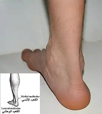 صورة القدم اليمني ، و الرسم للقدم اليسرى. الكعب الإنسي و الكعب الوحشي.