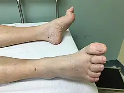 اصبع القدم وشكل المطرقة واضح