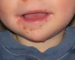 مرض اليد والقدم والفم