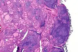 The غدة درقية of someone with Hashimoto's thyroiditis as seen with a microscope at low magnification
