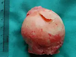 رأس الفخذ يظهر فتحة في الغضروف بسبب نخر الأوعية الدموية(التهاب العظم والغضروف السالخ) تمت إزالة العينة أثناء جراحة استبدال مفصل الورك.
