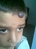 ورمم وعائي دموي على الجبهة يظهرعلامات التلاشي المبكر.