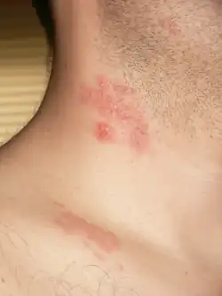 بثرات الهِربِس النُطاقي على العُنق والكتفين