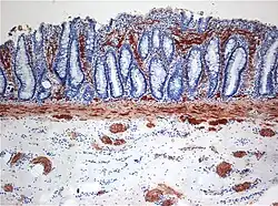 صورة مرضية نسيجية لمرض هيرشسبرنج.