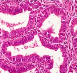 Histopathology of a well-differentiated endometrioid adenocarcinoma in the ovary