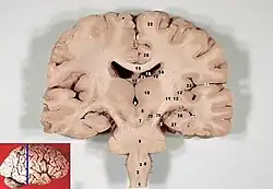 مقطع تاجي في المخ