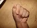 فرط الحركية في دوران مفصل الإبهام.