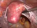 الرحم قبل استئصال الرحم