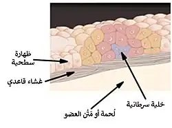 سرطانة لابدة