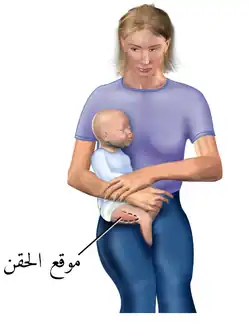 موقع الحقن في المتسعة الوحشية عند الأطفال