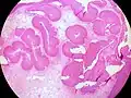 الورم الحليمي شنايدريان المقلوب (Inverted Schneiderian Papilloma) في تجويف الأنف.