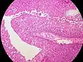 الورم الحليمي شنايدريان المقلوب (Inverted Schneiderian Papilloma) في تجويف الأنف مع خراج دقيق الحجم داخل الظهارة.