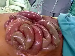 احتشاء أمعاء لاحظ تلون الأمعاء باللون الرمادي
