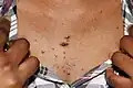 جدرة في شكل بثور صغيرة