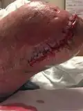 خلع مفصل الركبة بعد عملية البتر).