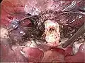 جدعة عنق الرحم (باللون الأبيض) بعد إزالة الرحم عن طريق عنق الرحم بالمنظار