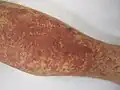 التهاب الأوعية الصغيرة في الجلد