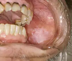لطاخ أبيض فموي على الغشاء المخاطي الشدقي.