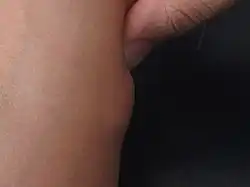 ورم شحمي في الساعد