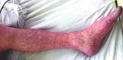 تزرق شبكي