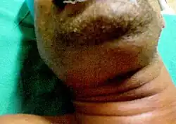 انتفاخ في منطقة الفك السفلي عند مريض مصاب بذُباح لودفيغ.