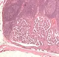 صورة مجهرية لسرطان الغدة الدرقية الحليمي النقيلي إلى العقدة الليمفاوية. صبغة H&E.
