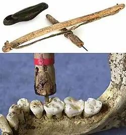 زراعة الأسنان في مهرغاره